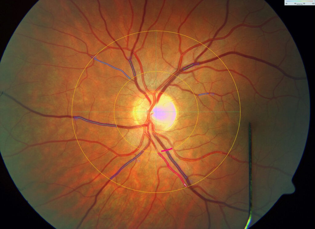 Retinopathy in the eye. 