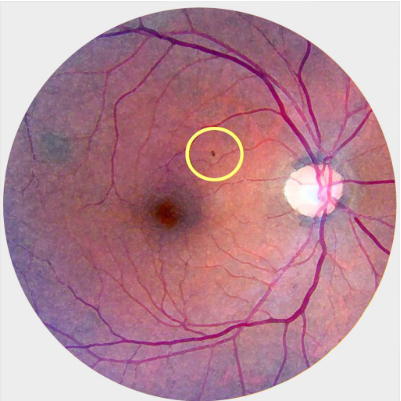 Close up of eye with background diabetic retinopathy.
