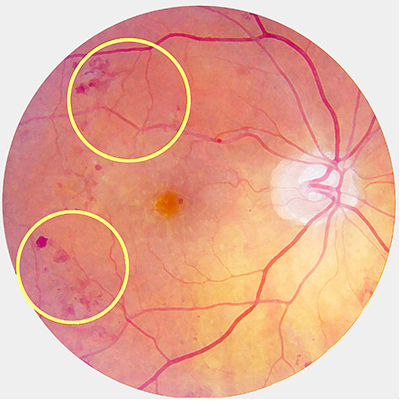 An image of an eye with Preproliferative Diabetic Retinopathy